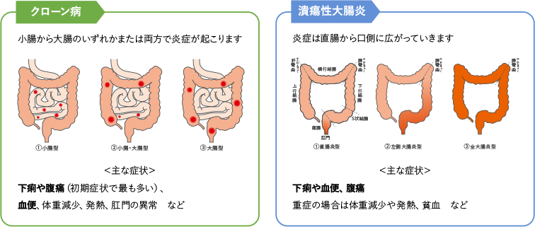 図1:IBDの主な症状