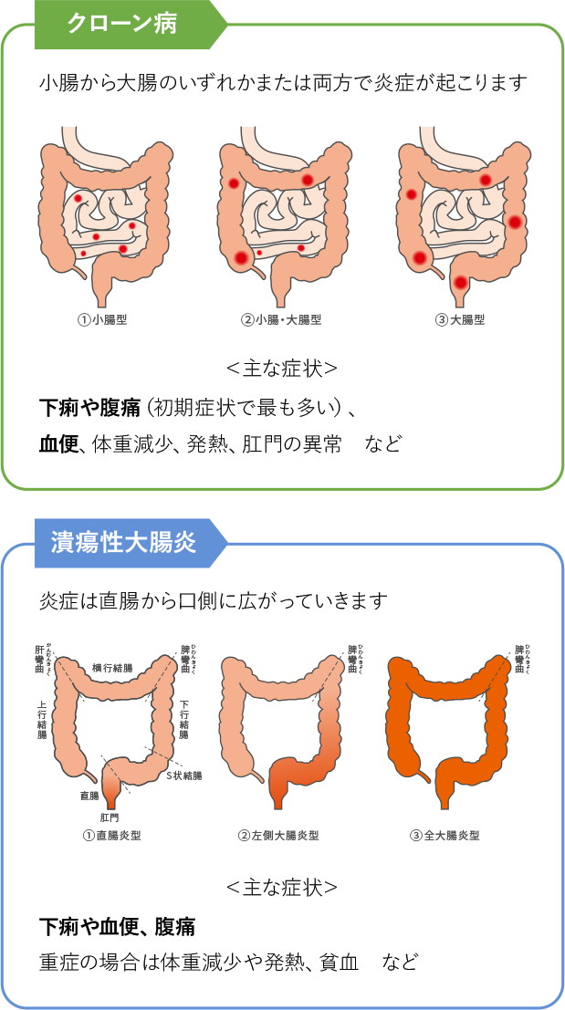 図1:IBDの主な症状