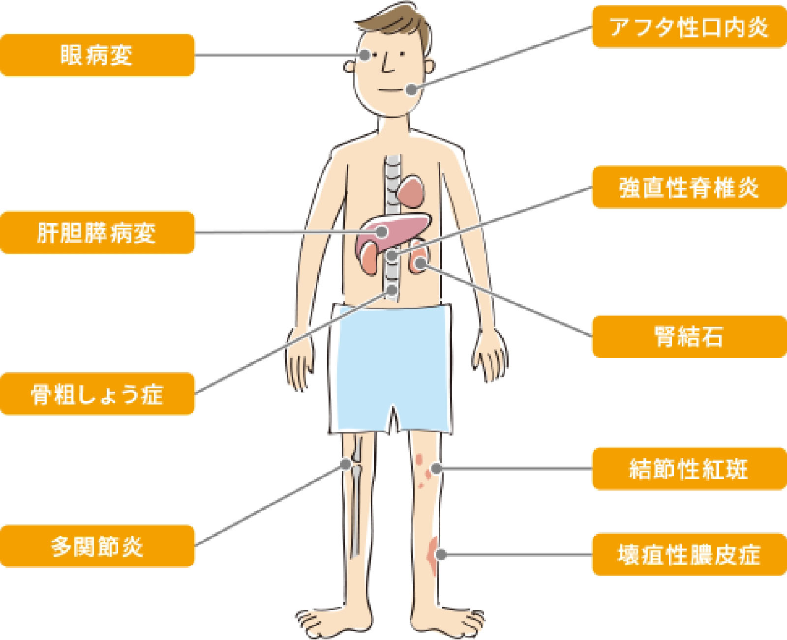 クローン病の腸管外合併症