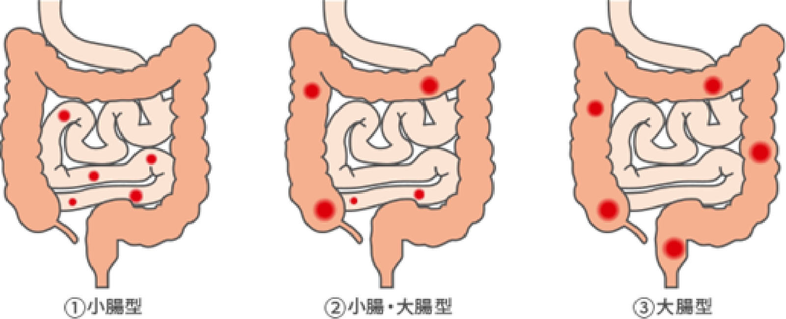 クローン病の腸管外合併症