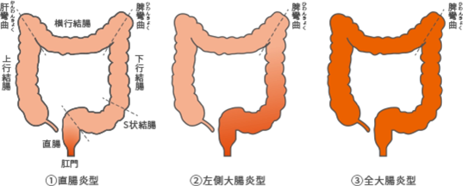 潰瘍性大腸炎の病変の広がりによる分類