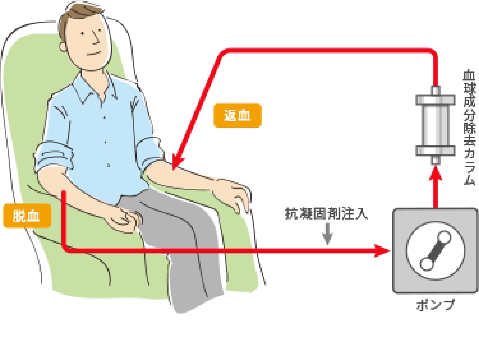 血球成分除去療法